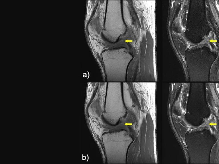 MRI Scans of Knee with Anterior Cruciate Ligament Tear That Show Similarity Between Conventional MRI Scan and Rapid MRI Scans Enhanced by Artificial Intelligence.
